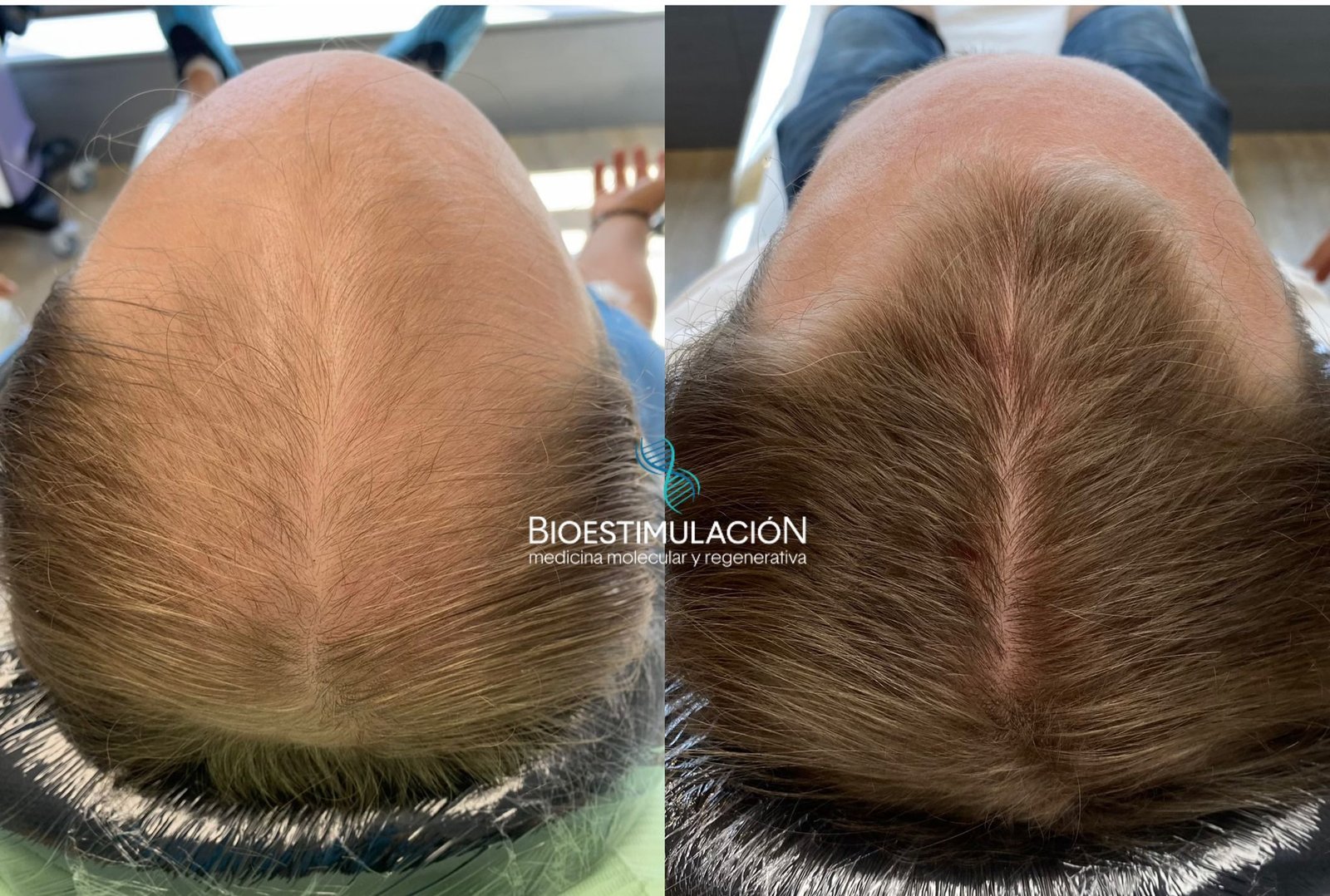 Tratamientos Capilares - Bioestimulación